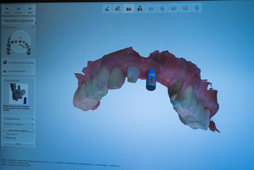Ein digitaler Zahnscan zeigt ein 3D-Modell eines Oberkiefers mit einer blau markierten Implantatmarkierung auf einer Softwareoberfläche.
