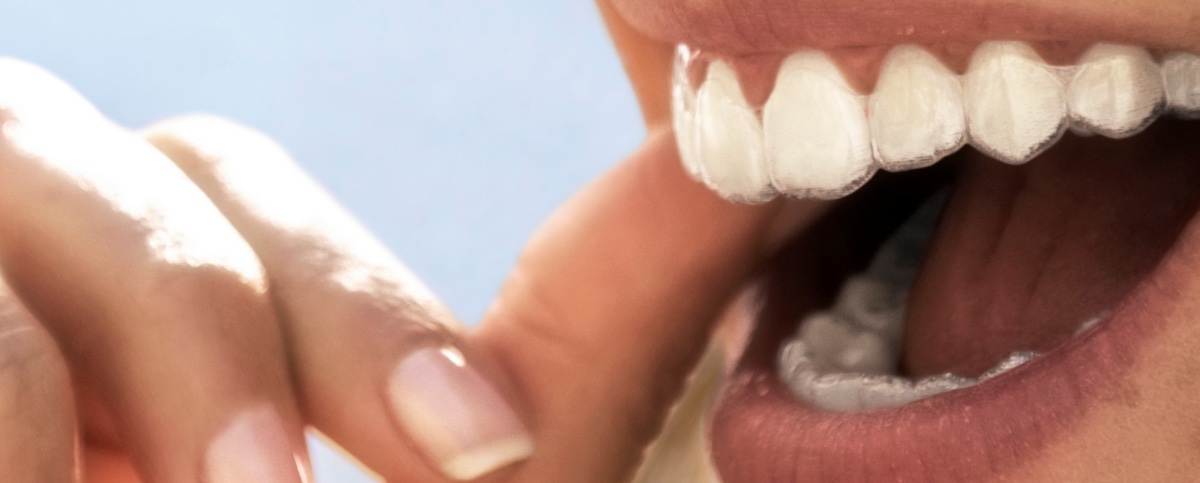 Nahaufnahme einer Person, die mit der Hand eine durchsichtige Zahnschiene auf ihre oberen Zähne setzt.